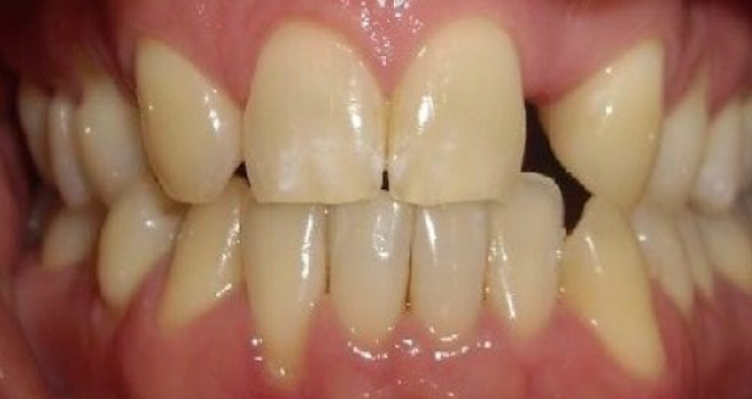 Teeth in a day before treatment